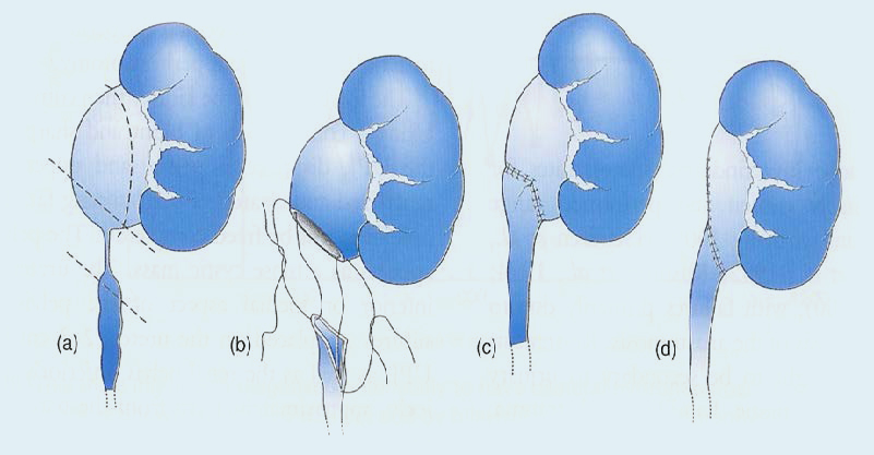 Laparoscopic Pyeloplasty